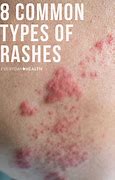 Image result for Most Common Skin Rashes