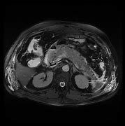 Image result for MRI MRCP Pancreas