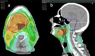 Image result for Head and Neck Radiation