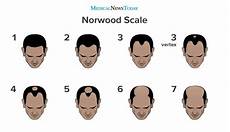 The Norwood Scale Understanding The Stages Of Balding