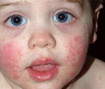 Image result for Fifth Disease and Cough