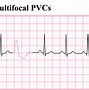 Image result for Ventricular Ectopics On Apple Watch ECG