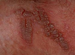 Image result for Severe Condyloma