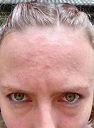 Image result for Small Acne Bumps On Face
