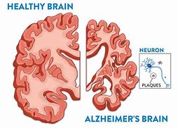 Image result for Alzheimer Disease Holes in Brain