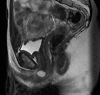 Image result for Groin Cysts Women