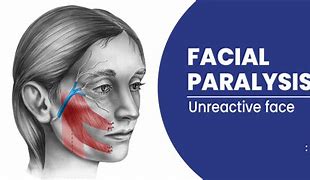 Image result for Facial Paralysis Symptoms
