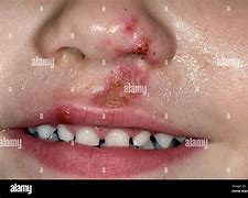 Image result for Impetigo Rash On Face