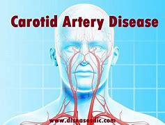 Image result for Carotid Artery in Neck Symptoms