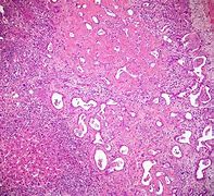 Image result for Polycystic Liver