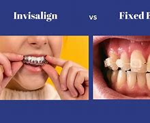 Image result for Lingual Braces vs Invisalign
