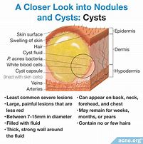 Image result for Sebaceous Cyst