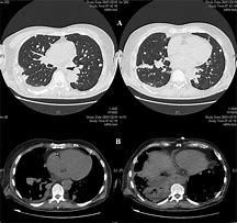 Image result for Show Me a Cat Scan of Lung Nodules