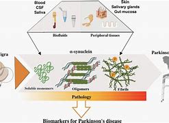 Image result for Parkinson's Biomarkers