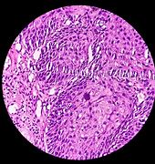 Image result for Papilloma Tumor