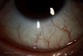 Image result for Laser Marking Toric Contact Lenses