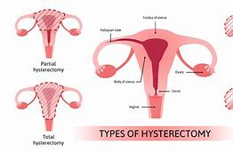 Image result for Hysterectomy