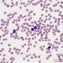 Image result for Hairy Cell Leukemia
