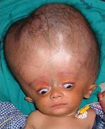 Image result for Sunset Eyes Hydrocephalus