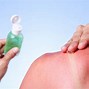 Image result for SunBurn Treatment