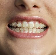 Image result for Ceramic Teeth Braces