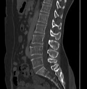 Image result for Osteophytes Lumbar Spine