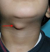 Image result for Lump Under Jaw Bone