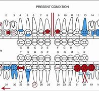 Image result for Retained Tooth Charting