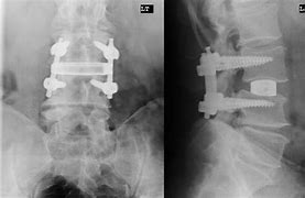 Image result for Robotic Lumbar Back Surgery