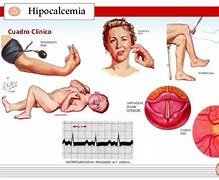 Image result for hipocalcemia