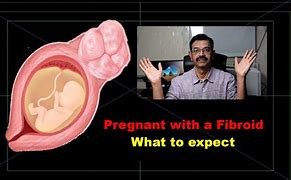 Image result for Pregnancy with Fibroids