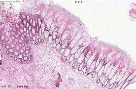 Image result for colitis_microscopica