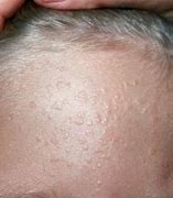 Image result for Crop of Warts On Face