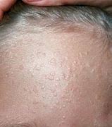 Image result for Skin Warts On Face