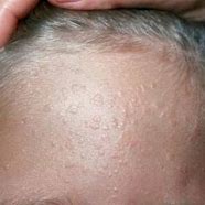 Image result for Genital Warts On Face