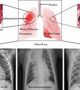 Image result for Lung Nodule Pneumonia