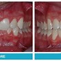 Image result for Removing 4 Teeth for Braces Before and After
