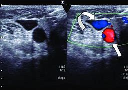 Image result for Anechoic Thrombus Ultrasound