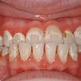 Image result for Not Brushing Teeth with Braces