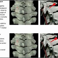 Image result for Tissues Elevation for Screw Placement