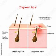 Image result for Ingrown Hair Symptoms