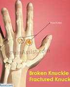 Image result for Broken Knuckle