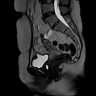 Image result for Gartner Duct Cyst MRI