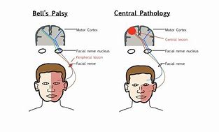 Image result for Bell's Palsy Forehead Sparing