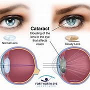Image result for Cataract Lens Replacement