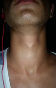 Image result for Giant Adam's Apple