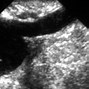 Image result for Ovarian Cancer Ultrasound