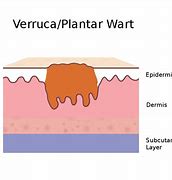 Image result for Plantar Wart vs Common Wart