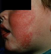 Image result for Fifth Disease in Children