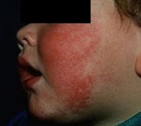 Image result for Fifth Disease Images
